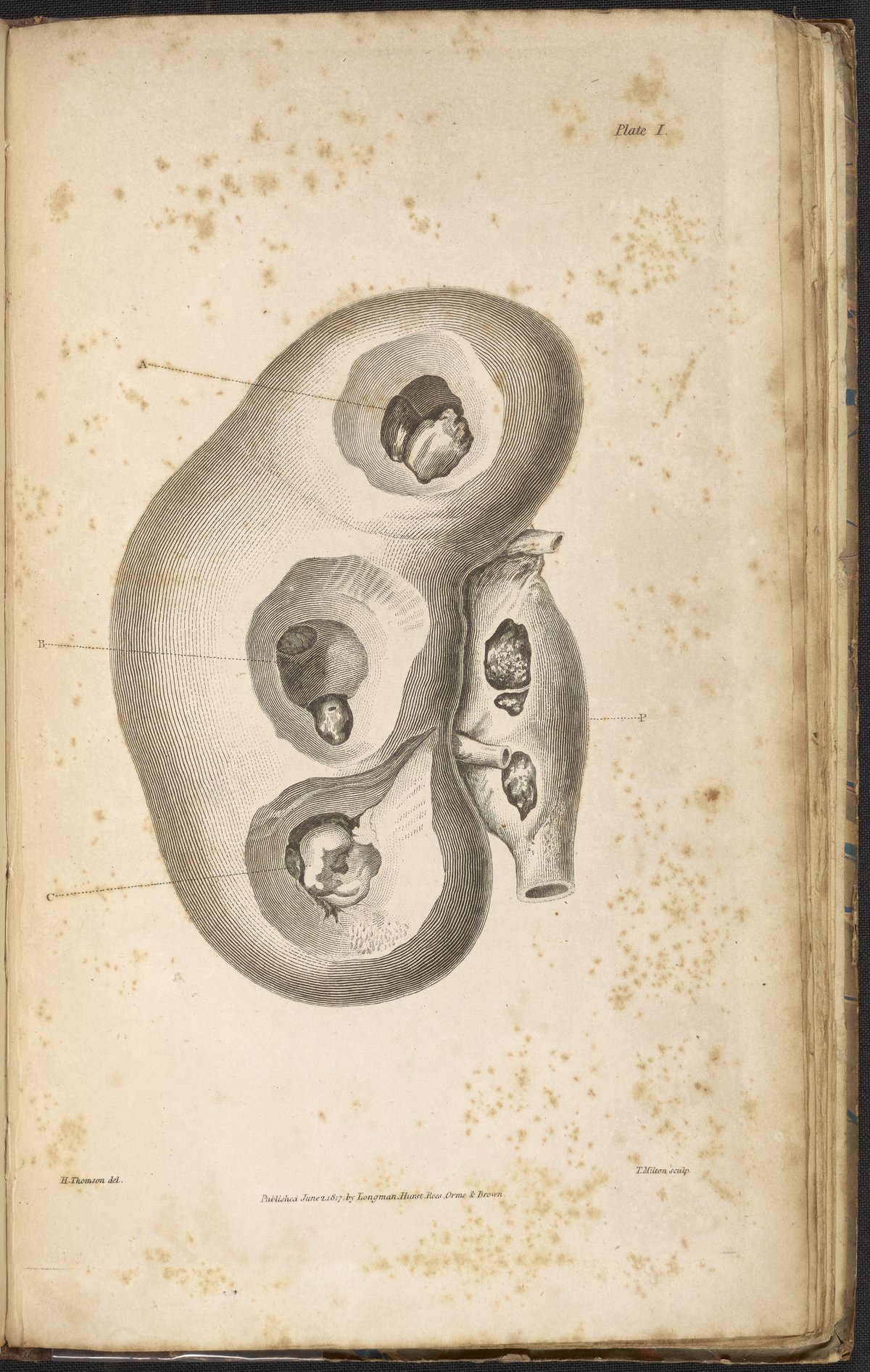An Essay on the Chemical History and Medical Treatment of Calculous ...